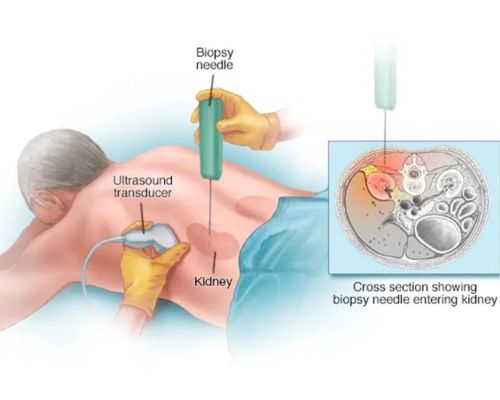 laser urology treatment for kidney in bangalore